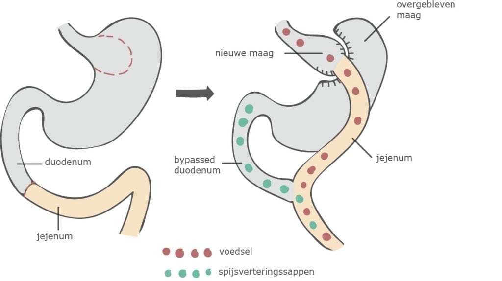 De Gastric Bypass Operatie Werkwijze Voor En Nadelen Maagverkleining Info