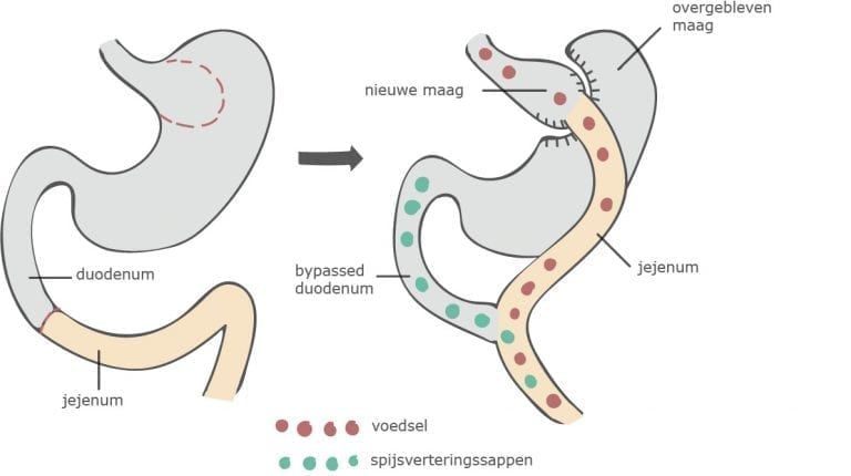 De Gastric Bypass Operatie Werkwijze Voor En Nadelen Maagverkleining Info